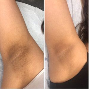 L80 Lactic Peel after treatment